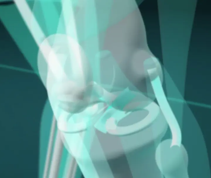 3D 膝蓋:十字韌帶和半月板的位置