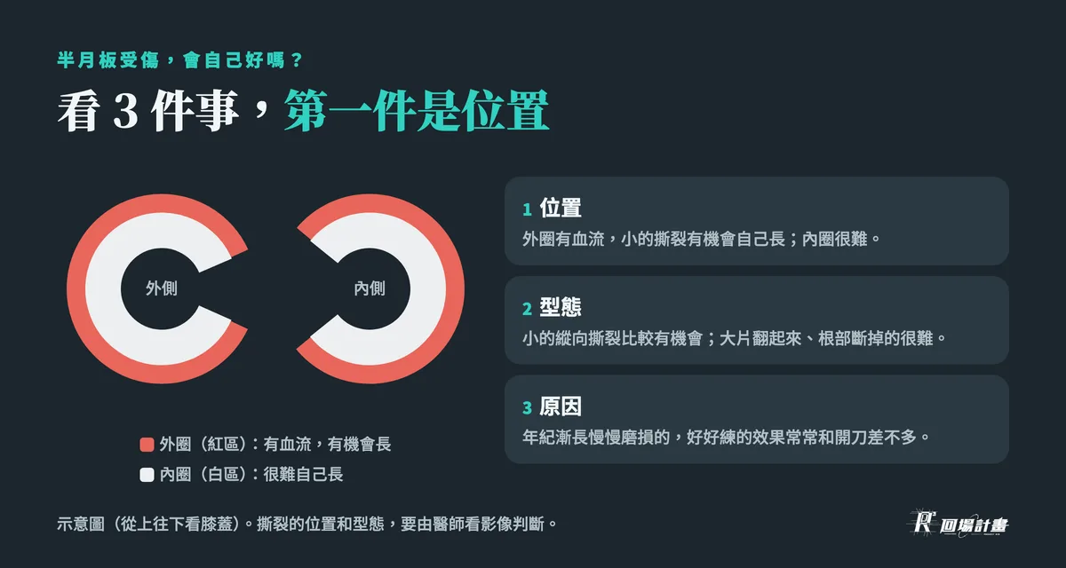 半月板受傷會自己好嗎:看位置(外圈紅區有血流有機會長、內圈白區很難)、型態、原因 3 件事